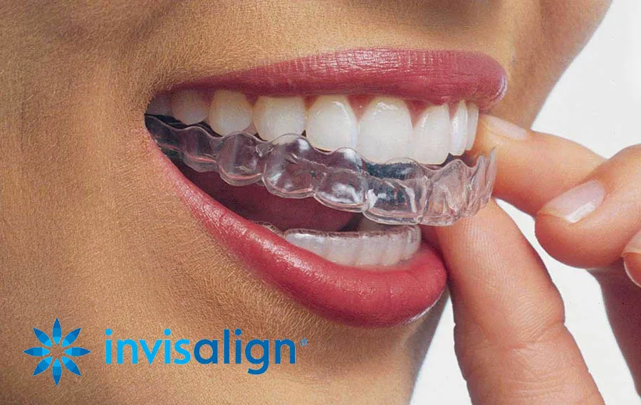 Alineadores transparentes Invisalign