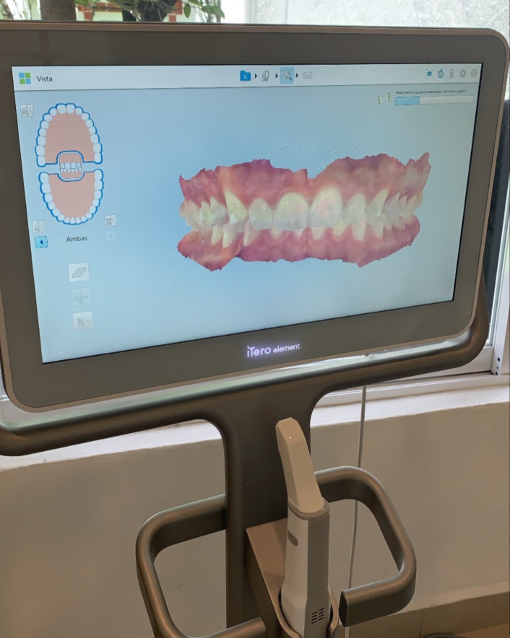 Escáner intraoral iTero en Smilica